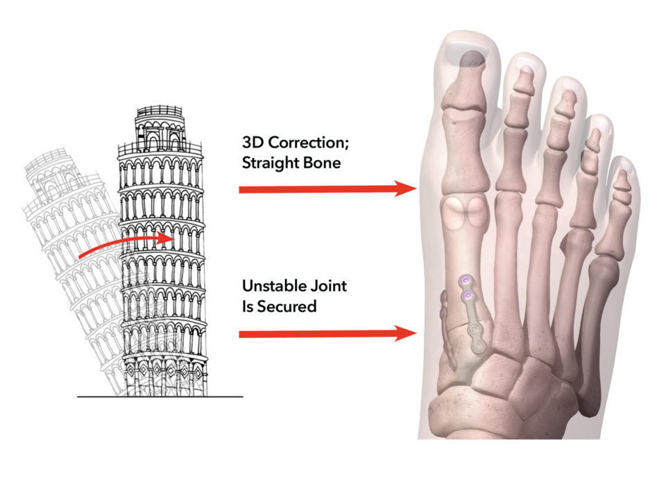 Lapiplasty D Bunion Correction Treace Medical Concepts Inc