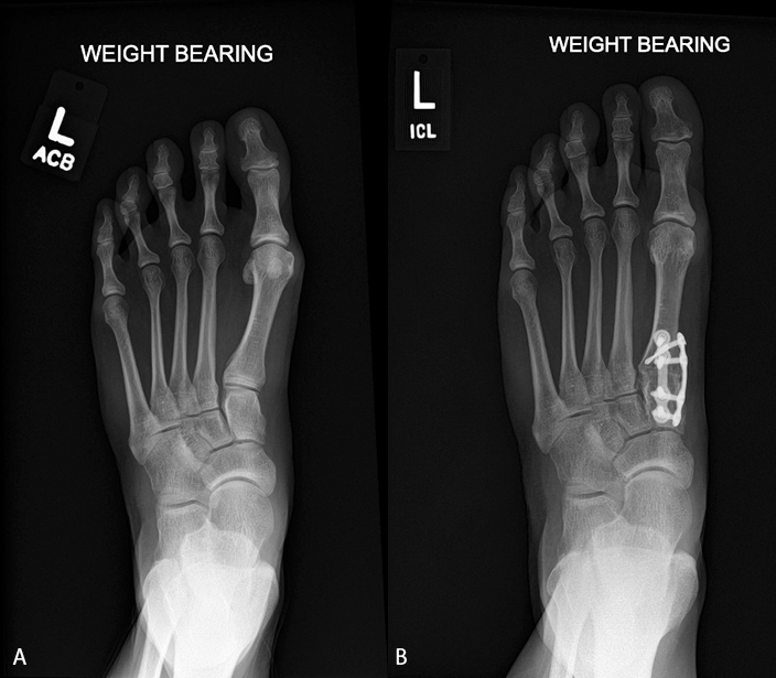 Treatment of Hallux Valgus Deformity Benefits from 3D ‘Revolution’ - Treace