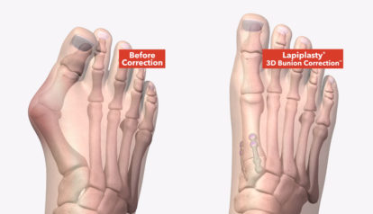 What is Lapiplasty?: Cutting-Edge Bunion Correction Explained