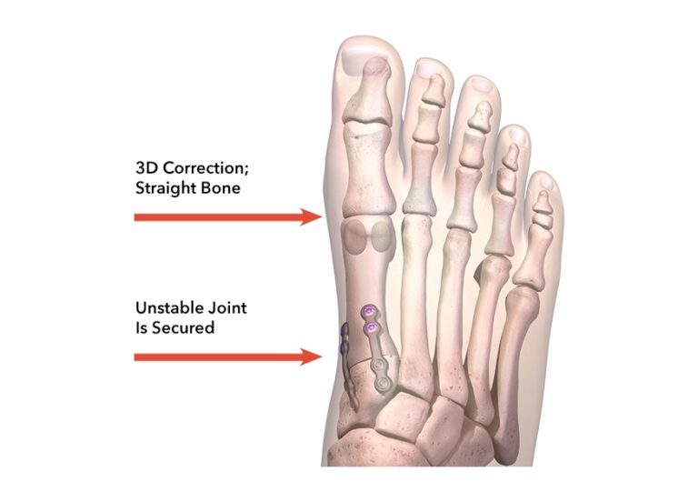 Lapiplasty® 3D Bunion Correction® | Treace Medical Concepts, Inc.