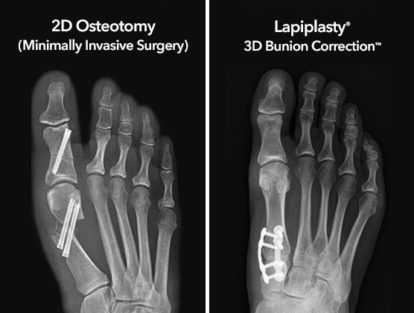 Lapiplasty® Mini-Incision™ Procedure | Treace Medical Concepts, Inc.