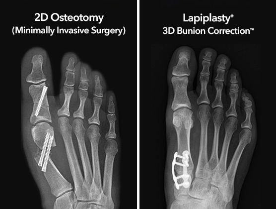 Lapiplasty® Mini-Incision™ System | Treace Medical Concepts, Inc.