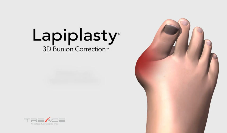 Lapiplasty® 3D Bunion Correction™ | Outpatient Bunion Surgery