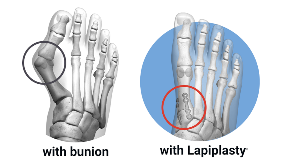 Lapiplasty® 101: Everything You Need to Know About Lapiplasty 3D Bunion ...