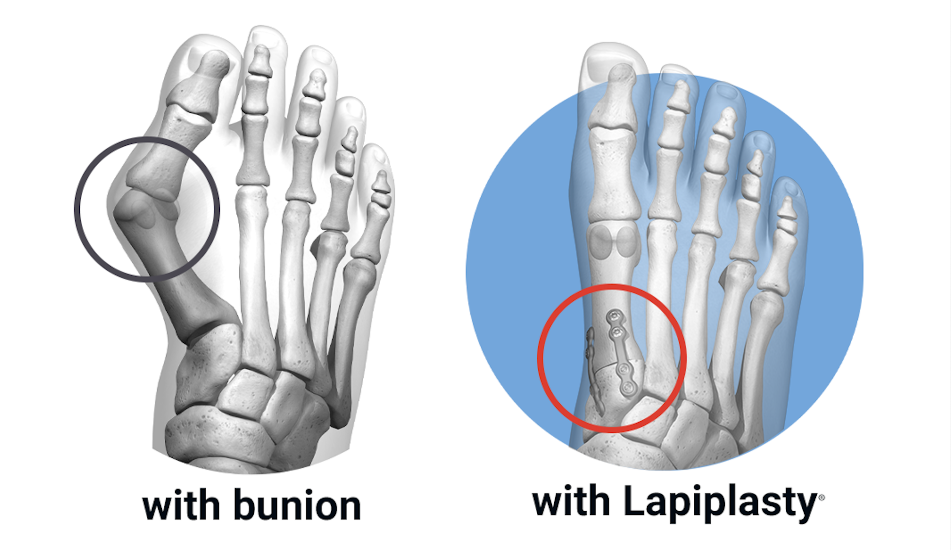 Lapiplasty® 101: Everything You Need To Know About Lapiplasty 3D Bunion ...