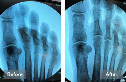 Hammertoe PEEK Fixation System - Treace