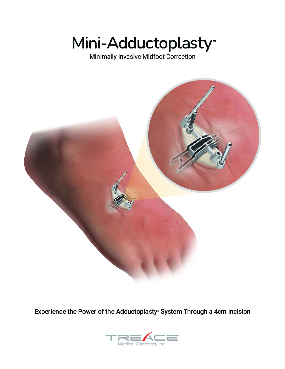 Mini-Adductoplasty™ Sales Sheet