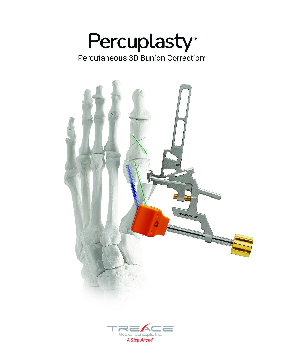 Percuplasty™ Overview